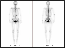 骨シンチグラフィ検査画像