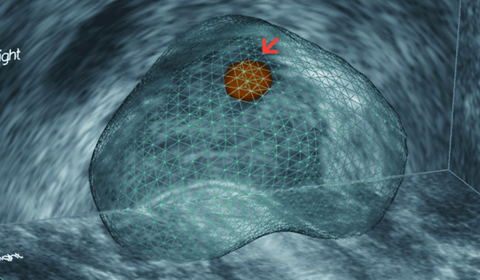 (図2)MRIで指摘された前立腺癌を疑うターゲット
