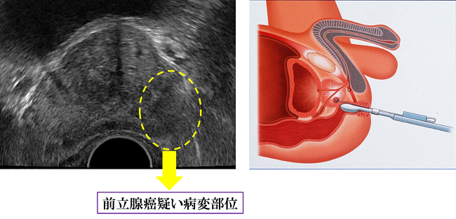 前立腺生検
