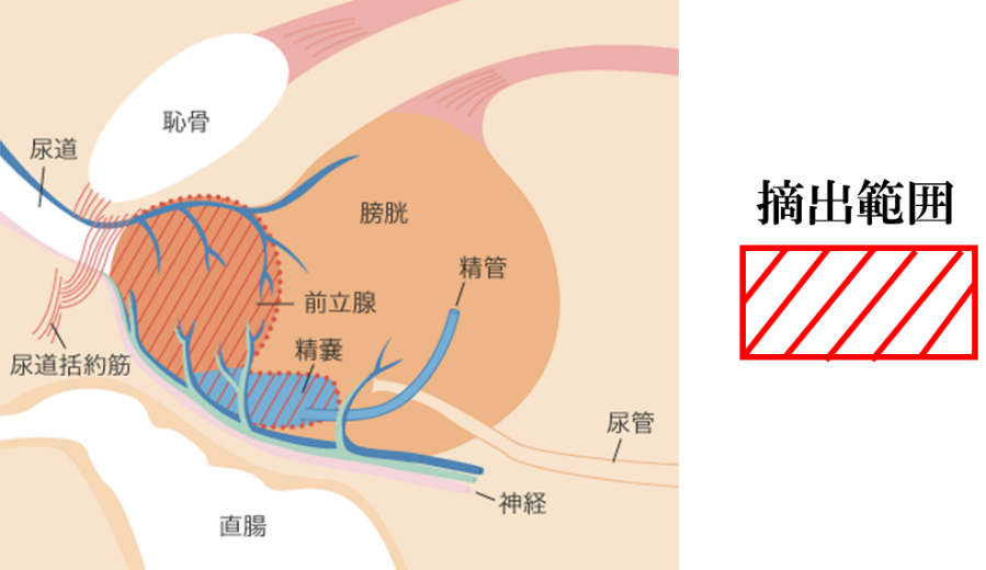 根治的前立腺全摘除術