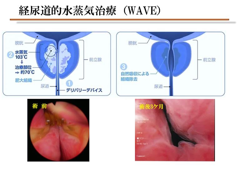 経尿道的水蒸気治療（WAVE)