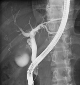 ERCP