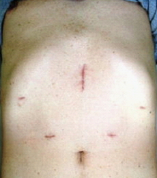 腹腔鏡補助下胃切除術の傷跡