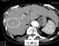 治療前の断層画像